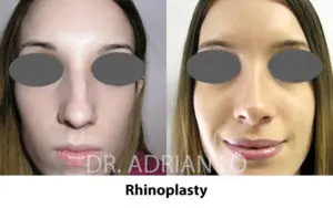 Rhinoplasty Before and After Patient Thumbnail 1