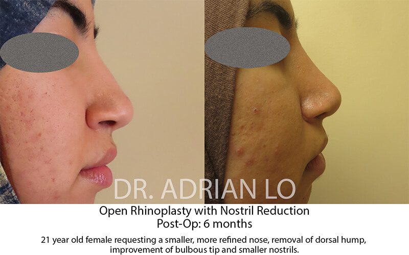 Rhinoplasty Before and After Patient 3