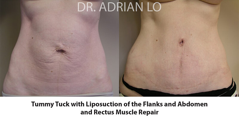 Tummy Tuck Before and After Patient 1