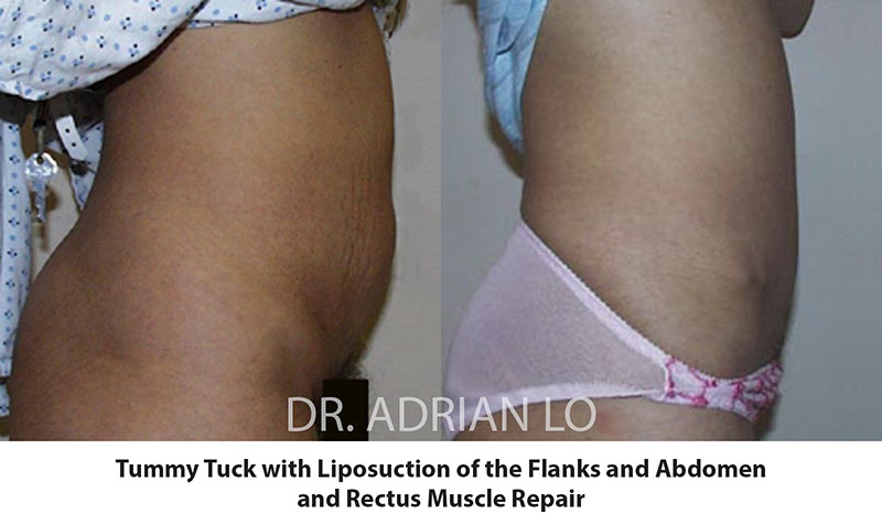 Tummy Tuck Before and After Patient 1