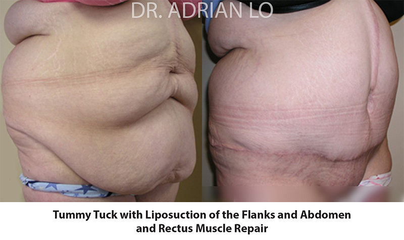 Tummy Tuck Before and After Patient 2