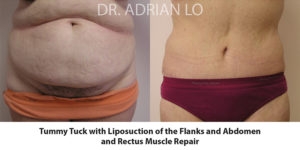 Tummy Tuck Before and After Patient Thumbnail 1