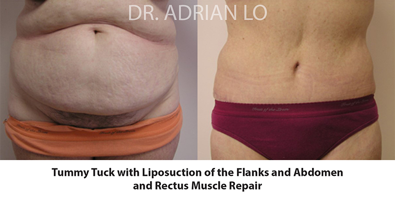 Tummy Tuck Before and After Patient 1
