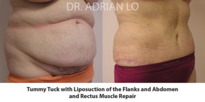 Tummy Tuck Before and After Patient Thumbnail 2