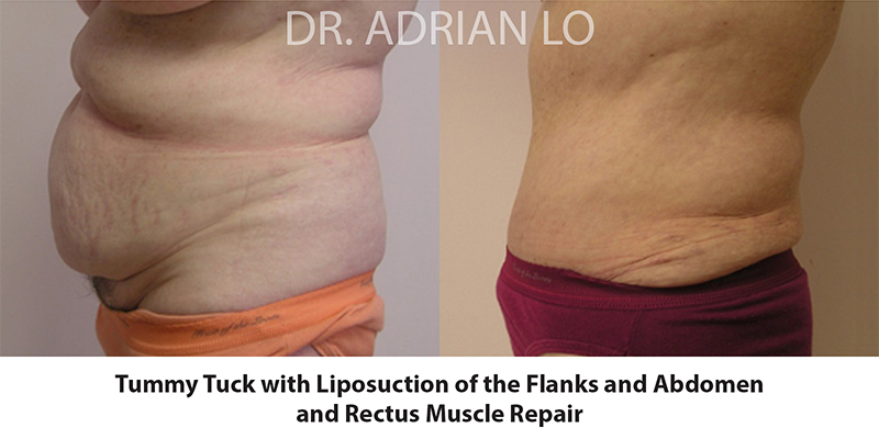 Tummy Tuck Before and After Patient 3