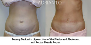 Tummy Tuck Before and After Patient Thumbnail 1