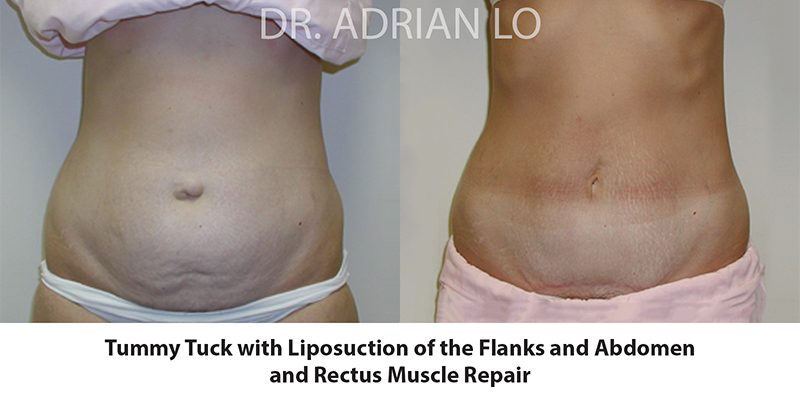 Tummy Tuck Before and After Patient 1