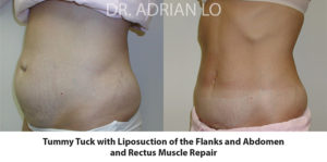 Tummy Tuck Before and After Patient Thumbnail 2
