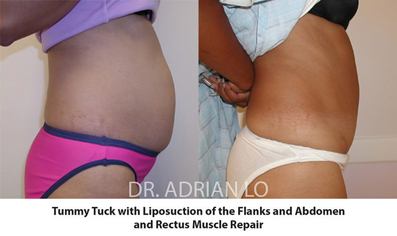Tummy Tuck Before and After Patient 1