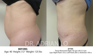 Tummy Tuck Before and After Patient Thumbnail 5